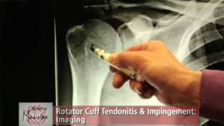 Rotator Cuff Impingement amp Tendonitis Part 2 Symptoms amp Evaluation [upl. by Ennirak451]