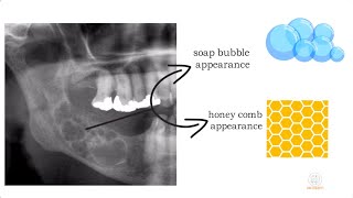 Ameloblastoma part 1 [upl. by Akinit]