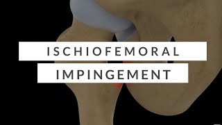 Ischiofemoral Impingement  A Nonsurgical Overview [upl. by Scutt]