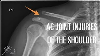 Acromioclavicular AC joint injury Mechanism of injury diagnosis and treatment [upl. by Slerahc]