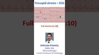 Tricuspid atresia – ECG [upl. by Neicul]