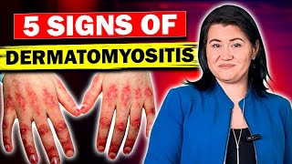 5 Signs of Dermatomyositis and Polymyositis [upl. by Yetnruoc299]