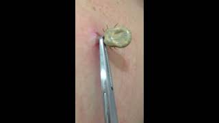 Tick removal by US doctor [upl. by Liahcim]