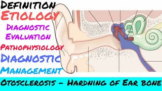 Otosclerosis  Nursing Sagar [upl. by Yauq876]