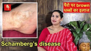 Brown spots on legs  Schamberg’s disease treatment  पैरो में काले काले दाग का इलाज [upl. by Beutler]