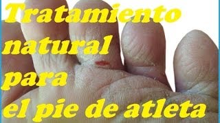 ELIMINAR LOS HONGOS EN LOS PIES Eliminate the FUNGI IN THE FEET [upl. by Avert]