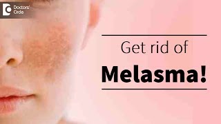 Melasma or pigmentation of skin Treatment available  Dr Deepak P Devakar [upl. by Ahseka351]