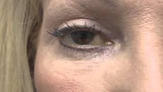 Management of PostBlepharoplasty Chemosis [upl. by Thelma]