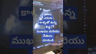 Breech presentation in 9th month drkranthigynecologist తొమ్మిదవ నెల లో ఎదురు కాళ్ళు [upl. by Balthazar]