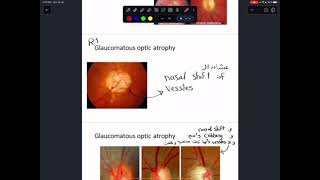 practical ophthalmology 2 [upl. by Snowman495]