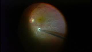 Vitrectomy for Retinal Detachment  Macula is Detached [upl. by Roice467]