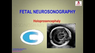 Fetal Neurosonography – Holoprosencephaly [upl. by Aratahs]