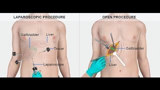 What are Gallstones Causes Symptoms  Treatment of Gallstone [upl. by Vani531]