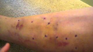 Varicose Vein Recovery  Video 2  8 days Post Surgery [upl. by Leanatan786]