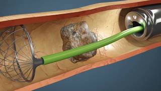 Como é feita a Cirurgia de Pedra nos Rins Vídeo da cirurgia em 3D [upl. by Eelyram]