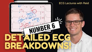 Improve your EKG Skills test yourself  ECG No 6 [upl. by Royal867]