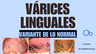 Variante de lo normal VARICES LINGUALES [upl. by Glass]