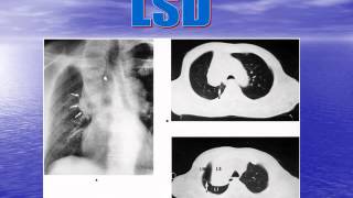 RADIOLOGIE ATELECTASIE LOBAIRE ET SEGMENTAIRE 3 [upl. by Kosey]