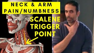 NECK amp ARM pain Relief Scalene Muscle Trigger Points [upl. by Eleda]