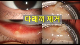 다래끼 제거 영상 Chalazion removal [upl. by Nevile]