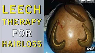 Leech Therapy  Leach In Hair  Hair Loss Treatment  Leech Therapy For Hair Loss  Health Tips [upl. by Nivad]