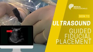 Ultrasound Guided Fiducial Placement for Stereotactic Radiotherapy [upl. by Crescint]