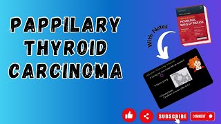 Papillary Thyroid Carcinoma  Thyroid Neoplasms Part2  Systemic Pathology  Robbins [upl. by Onibas]