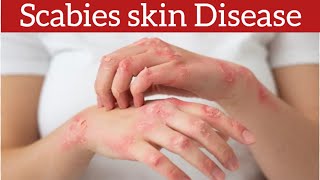 Scabies Signs Symptoms Causes and Treatment [upl. by Sitra]