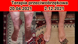 Obrzęk nógi żylne i limfatyczne  objawy terapia i efekt zdrowotny [upl. by Molini]