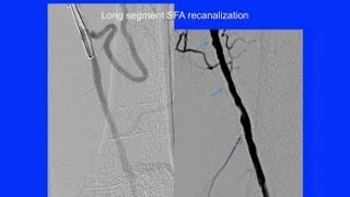 Options to Improve Endovascular Treatment of Claudication and CLI  UCSF Vascular Surgery Symposium [upl. by Annamarie129]