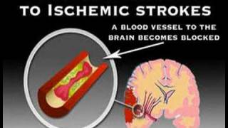 Symptoms of Stroke Stroke 3 [upl. by Ynnam]