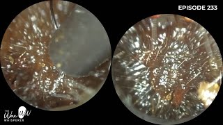 233  Bilateral Ear Wax Removal using the WAXscope®️ [upl. by Yorgos]