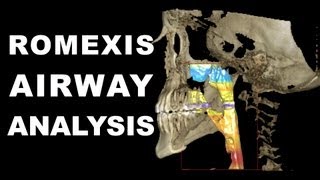 Romexis Airway Analysis [upl. by Audsley]