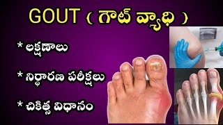 GOUT Causes Symptoms and Treatment in Telugu [upl. by Gun381]