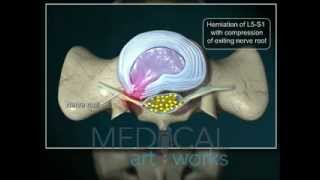 3D Medical Animation  L5S1paracentraldischerniation with compression of nerve root [upl. by Jahn986]