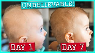 Plagiocephaly 1 Week Update Using Baby HelmetDoc Band 1 Week [upl. by Bugbee919]