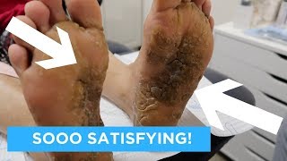 EXTREMELY SATISFYING AND RELAXING CALLUS CARE [upl. by Montanez]