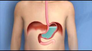 Heartburn Acid Reflux GERDMayo Clinic [upl. by Enilauqcaj]