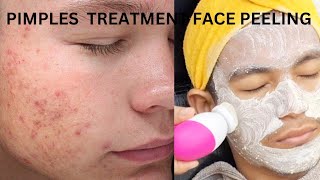 Acne Face peeling Treatment  30Days Beautician Course Class Day 27 [upl. by Gamali]