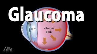 Development of Glaucoma Animation Open Angle vs Angle Closure Glaucoma [upl. by Sabelle]