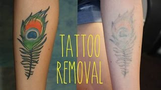 How to Remove a Tattoo  The Most Effective Treatment [upl. by Coppinger]