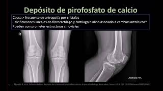 Radiología en 5 minutos Depósito de pirofosfato de calcio [upl. by Dave]