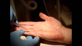 Dr Patrick Treacy demonstrates Botox for Sweaty Palms [upl. by Letha319]