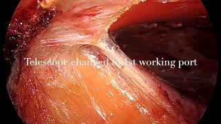 eTEPRS for umbilical hernia with divarication of recti [upl. by Atthia]