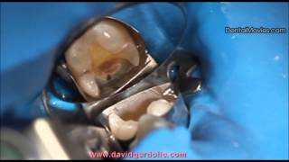 Onlay preparation on tooth 36 with distal margin coronal relocation [upl. by Kcerred]