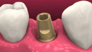 Restoring dental implants video BioHorizons [upl. by Sheya194]