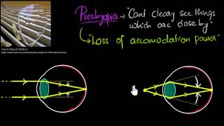 Presbyopia [upl. by Edmea]