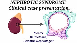 NEPHROTIC SYNDROME Clinical Case Presentation [upl. by Anehs]