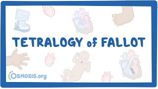 Tetralogy of Fallot Year of the Zebra [upl. by Ondrea]