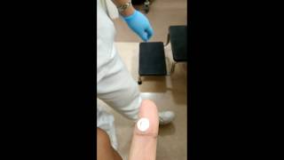 How to treat Warts Cryotherapy [upl. by Rew915]